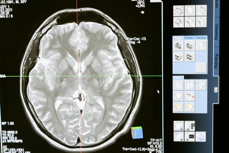 Invisible Injuries: The Lingering Effects of Concussions Beyond the Field