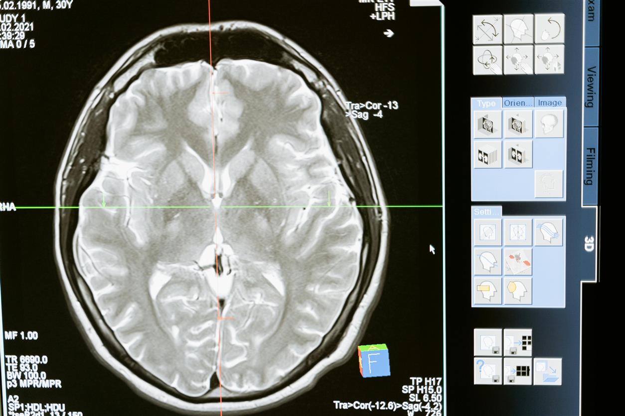 Invisible Injuries: The Lingering Effects of Concussions Beyond the Field